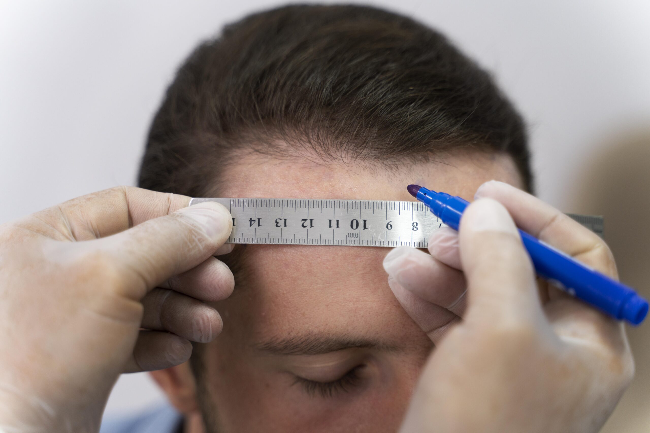 Combien coûte une greffe de cheveux et pourquoi les prix varient ?
